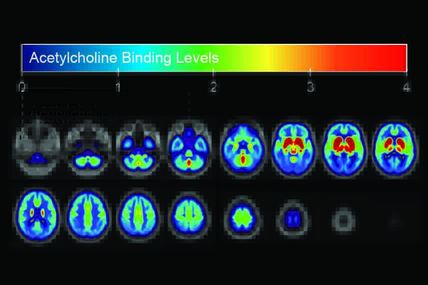 Online 3-Minute Test Provides Insight on Brain Chemistry and Alzheimer’s